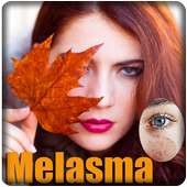 Melasma on 9Apps