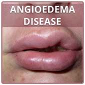 Angioedema Disease