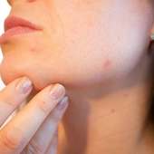 Treating Acne during Pregnancy