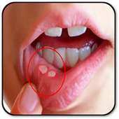 Remove a Mouth Ulcer