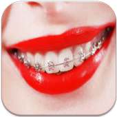 Braces on 9Apps