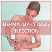 Dermatophytosis Infection