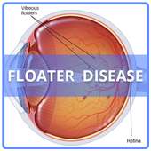 Floater Disease