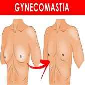 Gynecomastia ( Man Boobs )