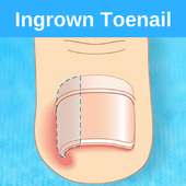 Ingrown Toenail on 9Apps