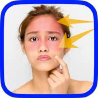 Home Remedies For Sunburn on 9Apps