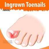 Ingrown Toenails‏‎ on 9Apps