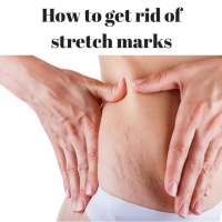 How to Get Rid of Stretch Marks on 9Apps