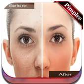 Face Blemishes Removal & Face Pimple Removal