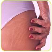 Get Rid of Body Stretch Marks Naturally on 9Apps