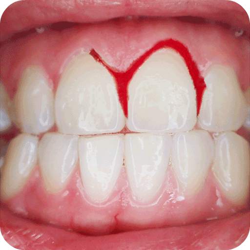 How To Stop Bleeding Gums