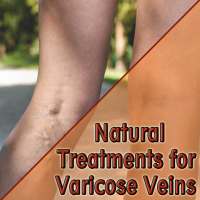 Natural Treatments for Varicose Veins