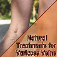 Natural Treatments for Varicose Veins on 9Apps