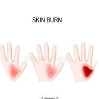 Skin Burns