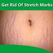 How To Get Rid of Stretch Marks