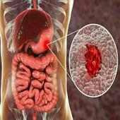 Ulcer Natural & Home Remedies