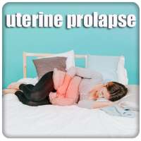 Uterine Prolapse