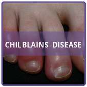 Chilblains Disease on 9Apps