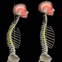 Kyphosis & Rounded Back by M&M on 9Apps