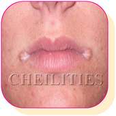 How to treat Angular Cheilitis at Home Naturally