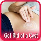 How To Get Rid of a Cyst‏‎ on 9Apps