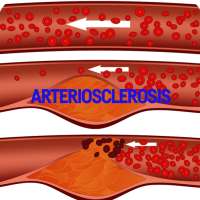 Arteriosclerosis Disease