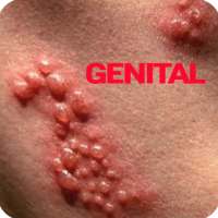 Genital Herpes on 9Apps