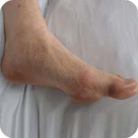 How to Get Rid of Gout