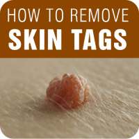 Skin Tag Removal - How to Remove Skin Tags