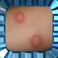 Ringworm Home Treatment on 9Apps