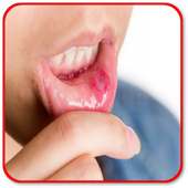 Remove a Mouth Ulcer