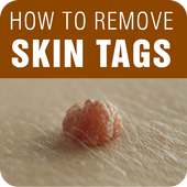 Skin Tag Removal - How to Remove Skin Tags