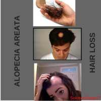 Alopecia / Hair Loss on 9Apps