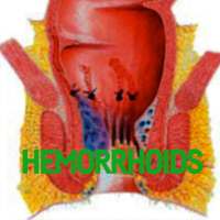 Hemorrhoids Disease