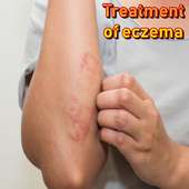 Home Remedies for Eczema on 9Apps