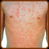 Psoriasis Natural Treatment Guide