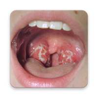 Tonsils Home Remedy