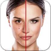 Acne Free on 9Apps