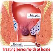 Treating hemorrhoids at home