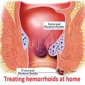 Treating hemorrhoids at home on 9Apps