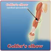 Golfers Elbow