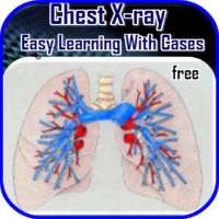 Chest X-ray Easy Learning