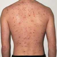 Home Remedy for Chicken Pox on 9Apps