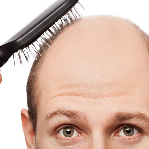 Hair Loss and Treatment