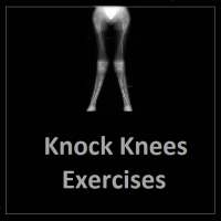 Knock Knees Egzersizleri