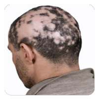 Alopecia Areata on 9Apps