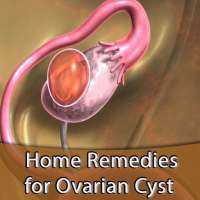 Home Remedies for Ovarian Cyst