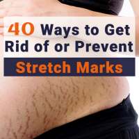 40 Ways to Get Rid of or Prevent Stretch Marks