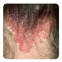 scalp psoriasis guide on 9Apps