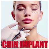 Chin implant